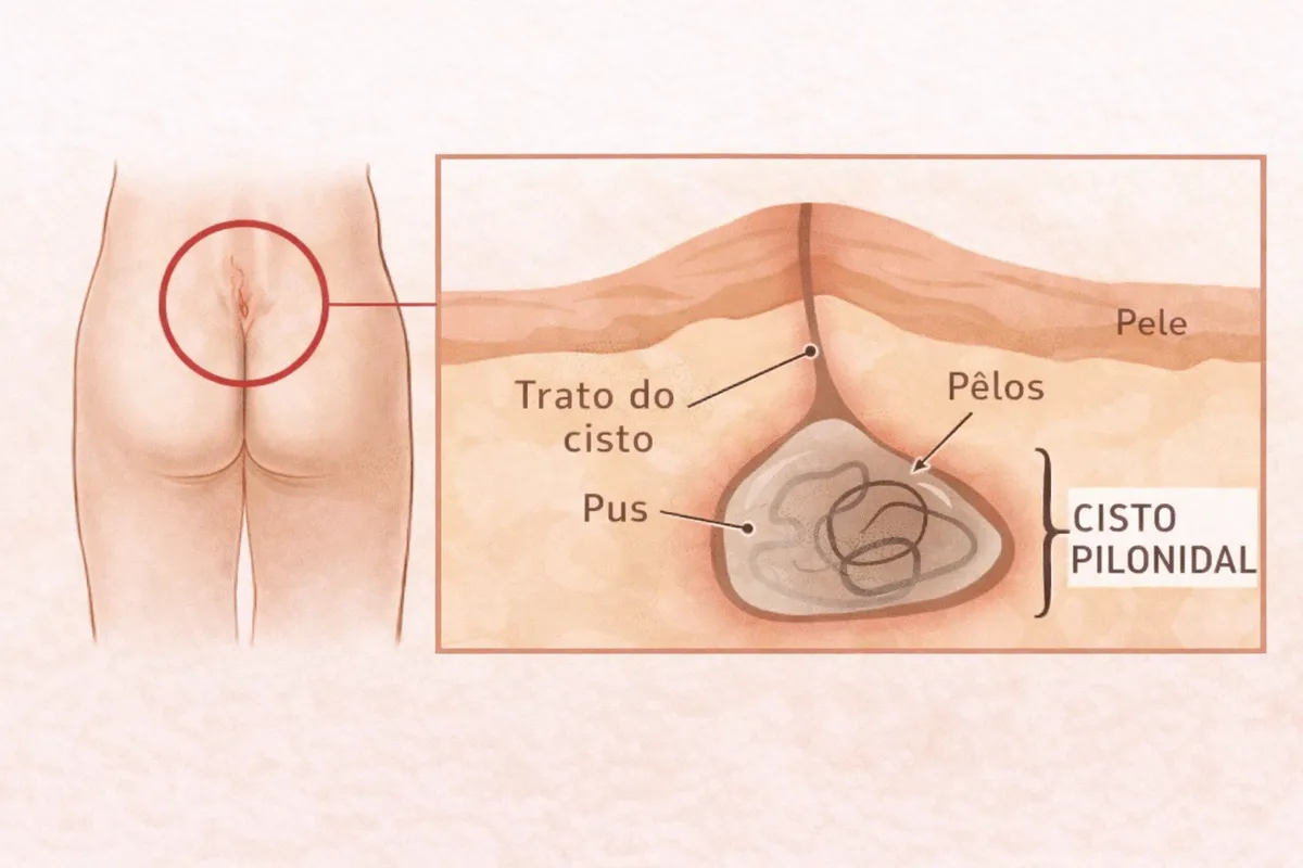 Ilustracao anatomica de cisto pilonidal