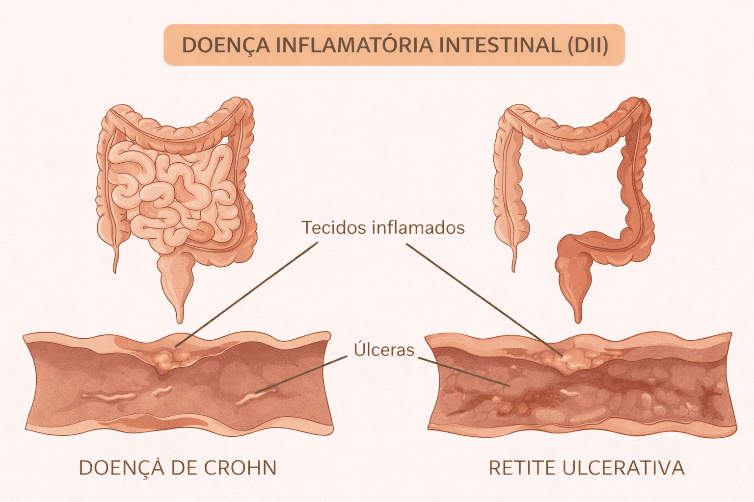 Ilustracao de doencas inflamatorias intestinais