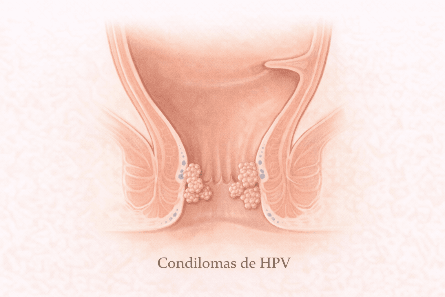 Ilustracao de condilomas associados ao HPV anal