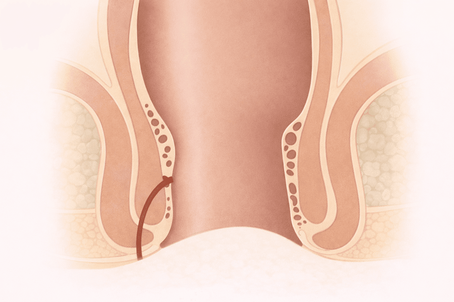 Ilustracao de fistula anorretal